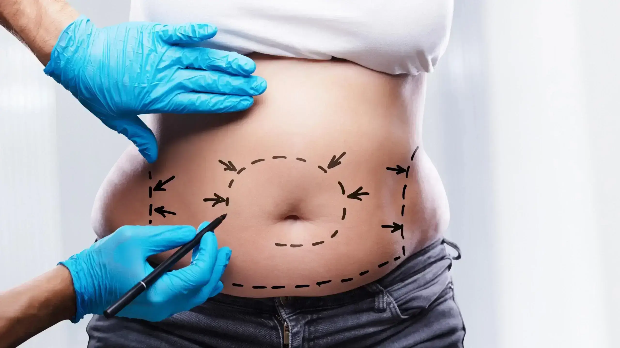 liposuction